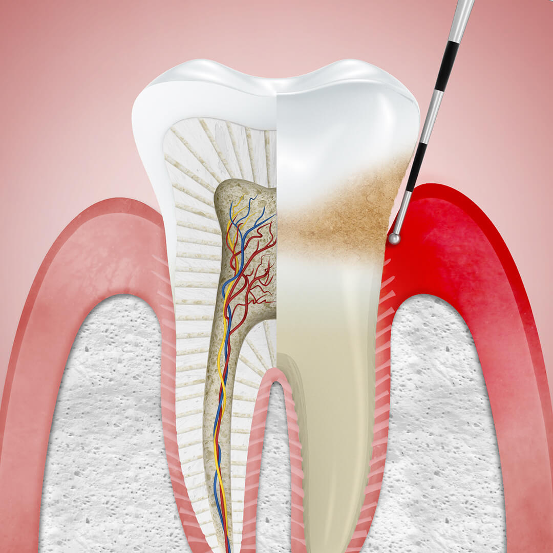 Treatment Mouthwash Corsodyl