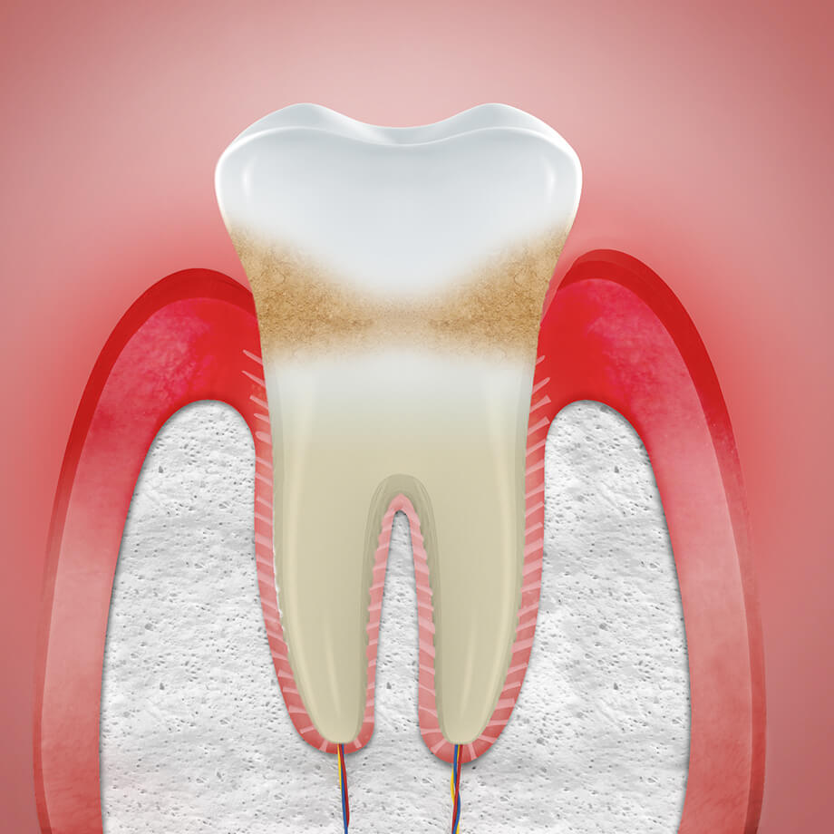 Swollen gums