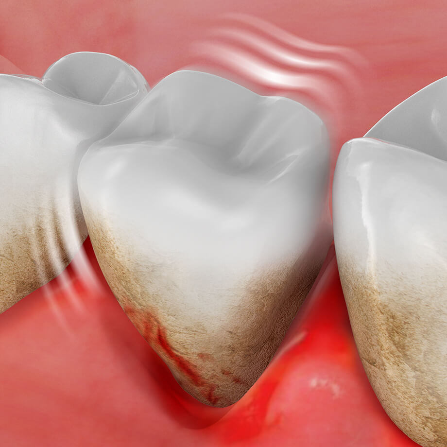 Bleeding gums and loose tooth