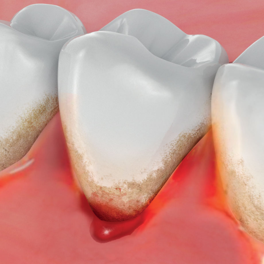 bleeding gums corsodyl stop gum teeth mean does disease blood brush brushing symptoms should treatment