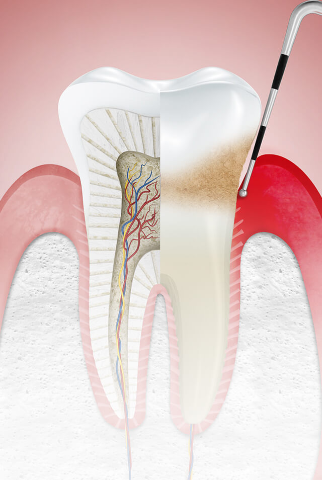 Stages of periodontitis
