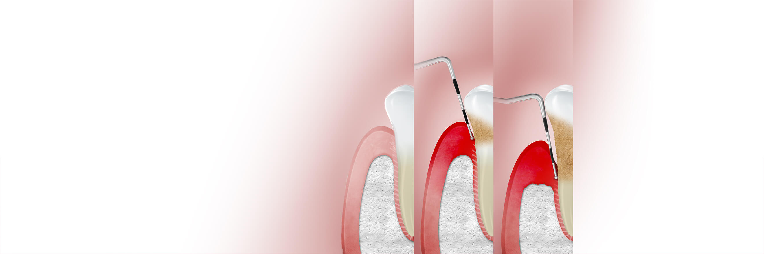 Stages of periodontitis